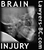 x-ray image of head and brain injury area 